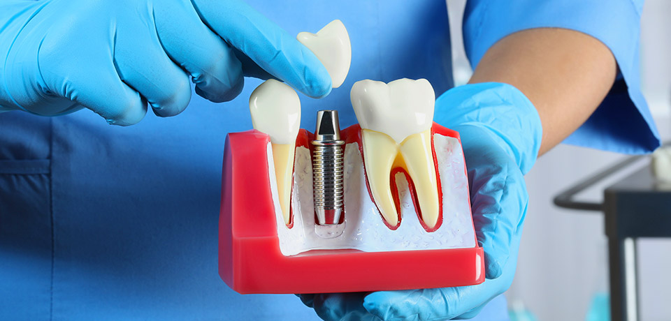 Cuidados y procedimientos de los Implantes Dentales